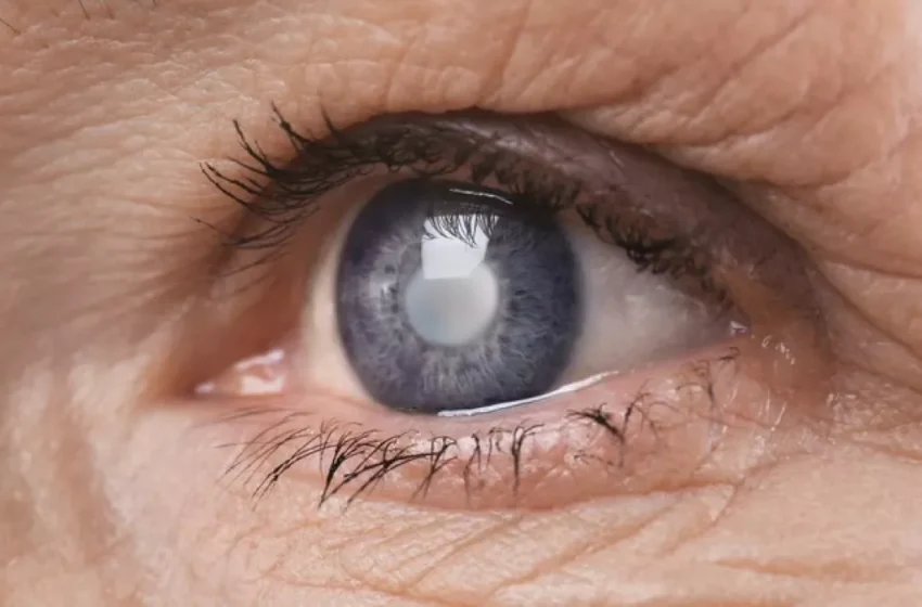 Cataratas: ¿cuáles son los síntomas de esta enfermedad en los ojos? Le contamos
